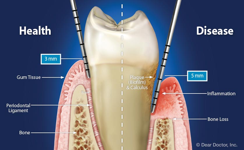 gum disease diagnosis explanation