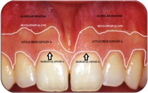 Diagram of exposed tooth roots